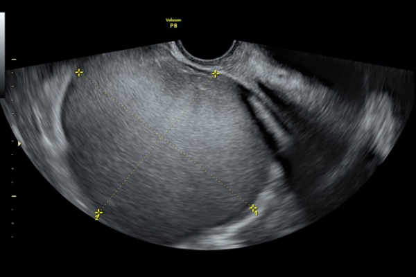 난소의 거대 자궁내막증(사진제공=센텀이룸여성의원)